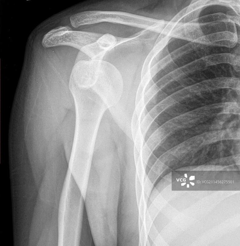 肩关节脱位X光片图片素材