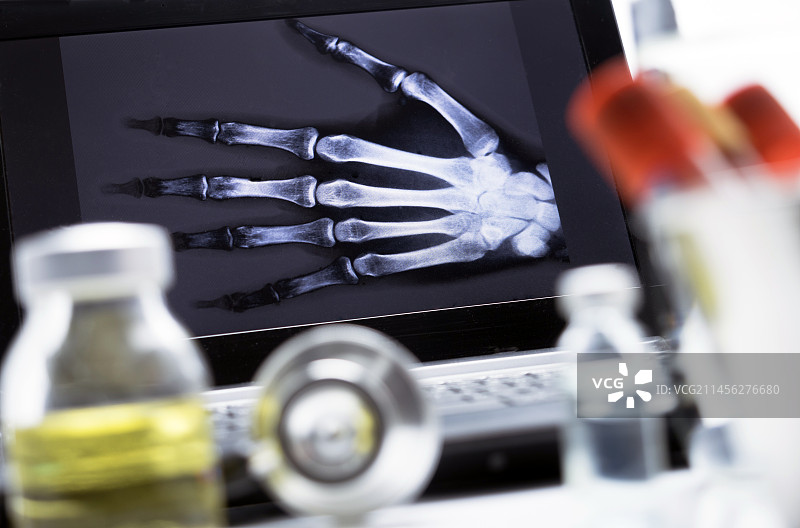 手部X光片图片素材
