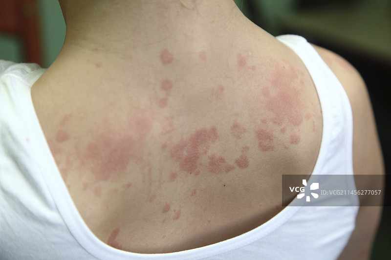 过敏性皮炎图片素材