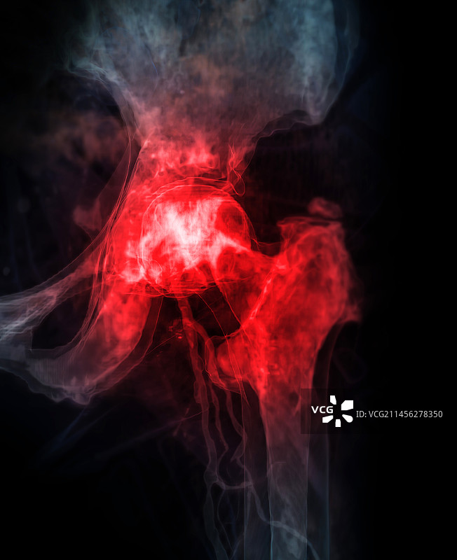 髋部疼痛概念图图片素材