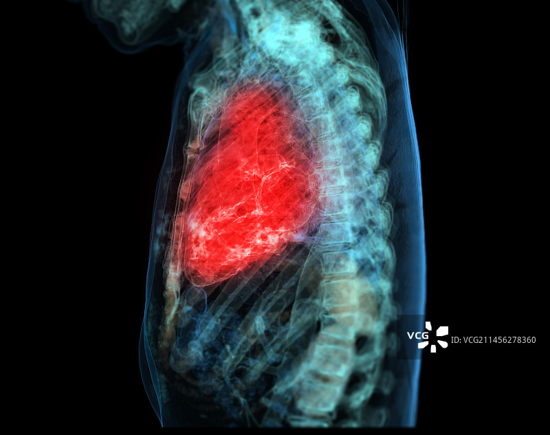 心脏CT扫描图片素材