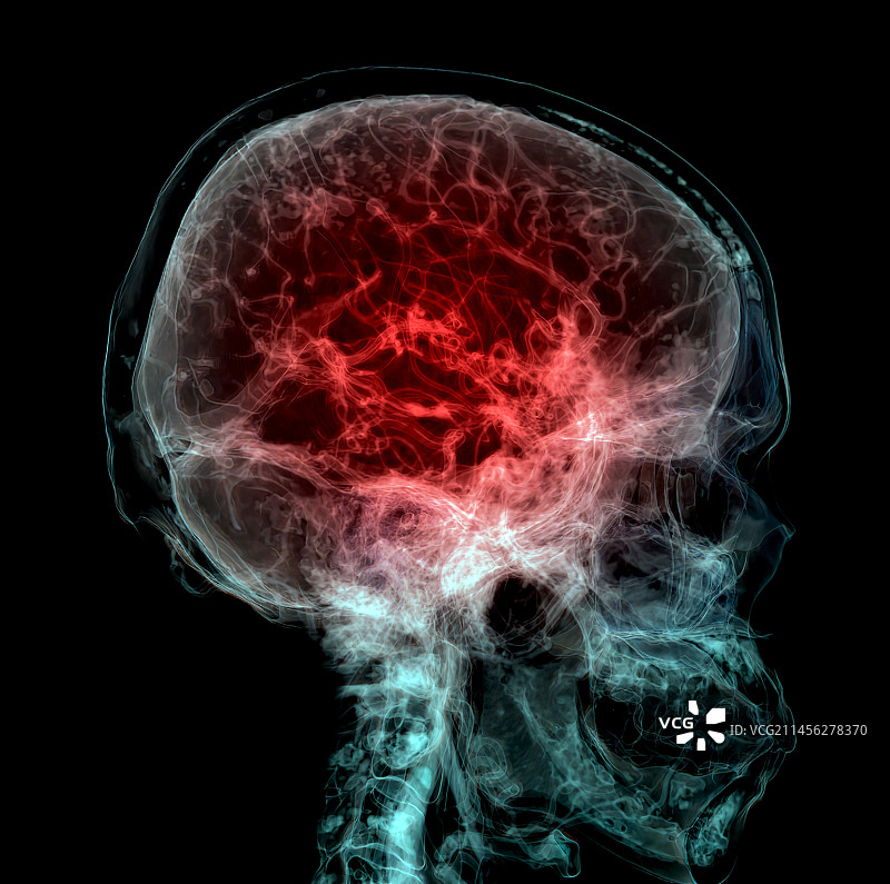 脑血管CT扫描图片素材