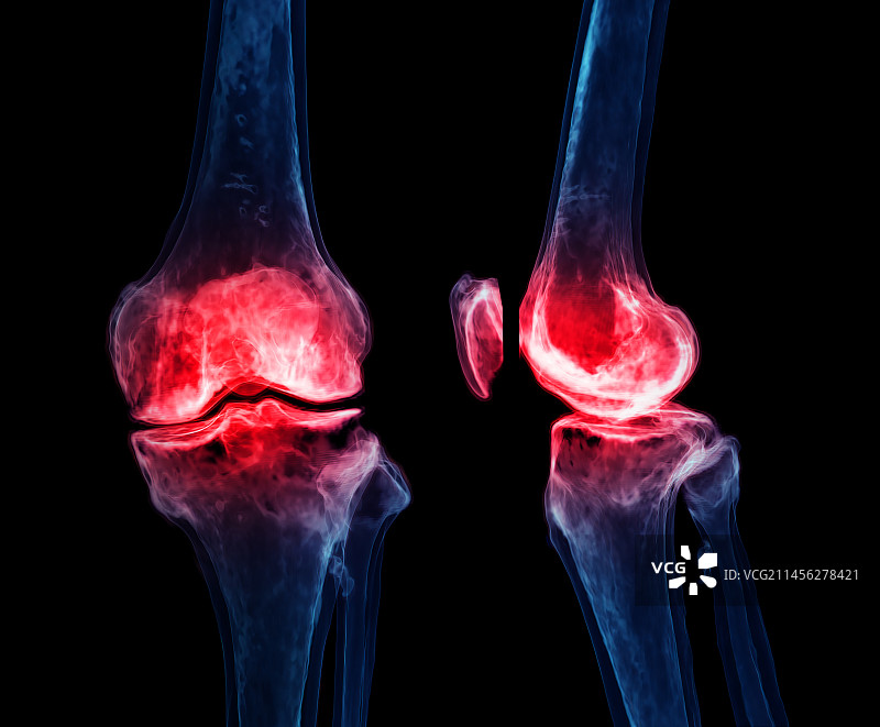 膝盖疼痛概念图图片素材