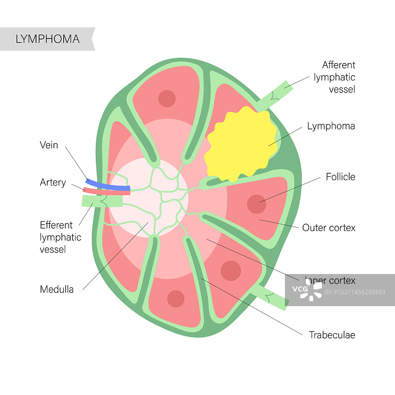 淋巴瘤，概念图图片素材