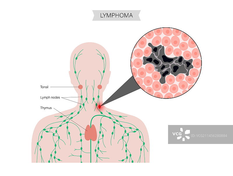 淋巴瘤，概念图图片素材