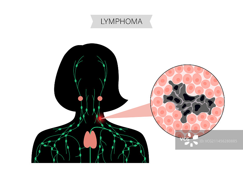 淋巴瘤，概念图图片素材