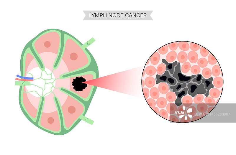 淋巴瘤，概念图图片素材