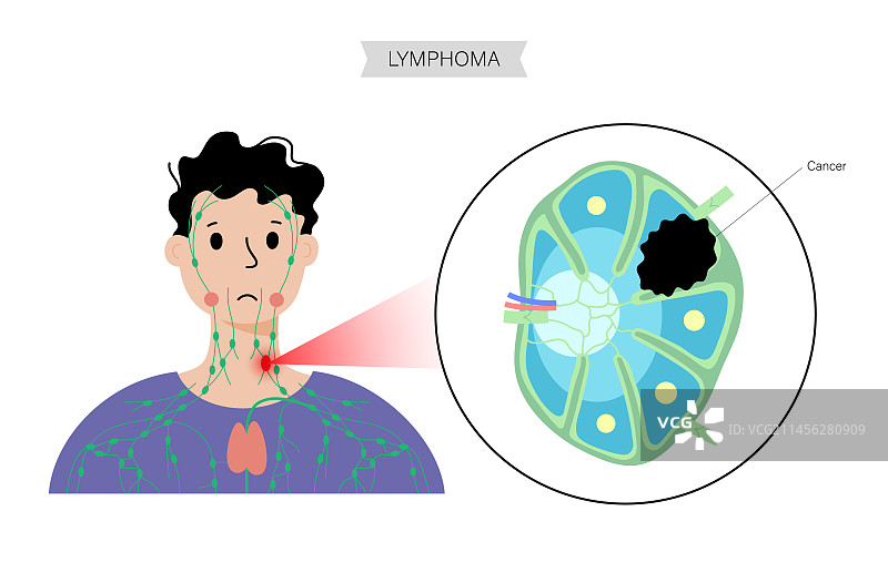 淋巴瘤，概念图图片素材