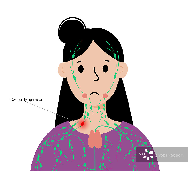 肿大的淋巴腺概念图图片素材