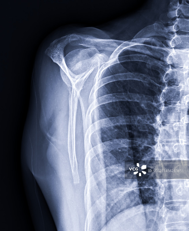 肩部骨折X光片图片素材