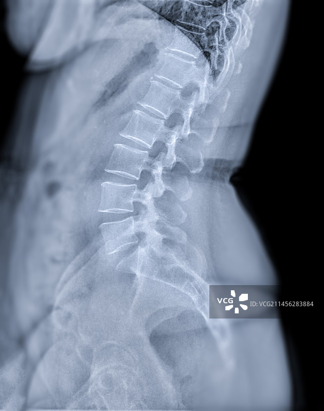 健康的脊椎X光片图片素材