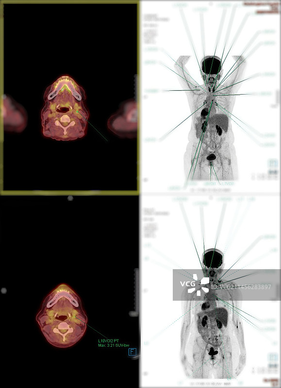 术后癌症复发PET/CT扫描图片素材