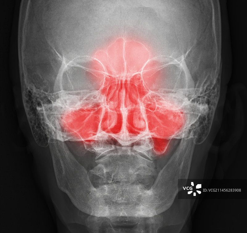 鼻窦疼痛概念X光片图片素材