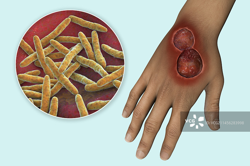 布鲁里溃疡分枝杆菌溃疡示意图图片素材