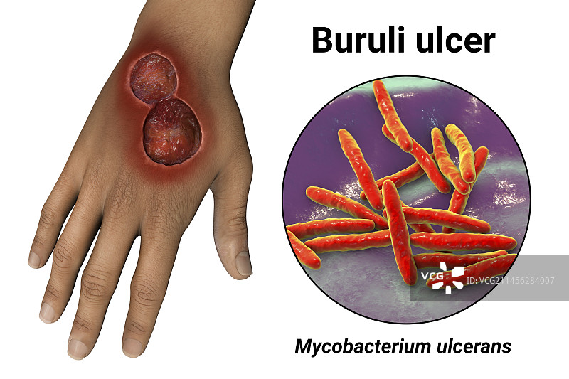 布鲁里溃疡分枝杆菌溃疡示意图图片素材