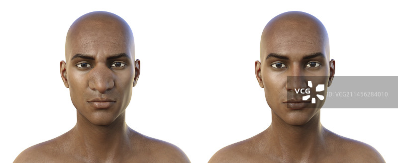 鼻面结合孢子菌病插图图片素材