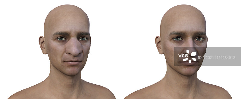 鼻面结合孢子菌病插图图片素材