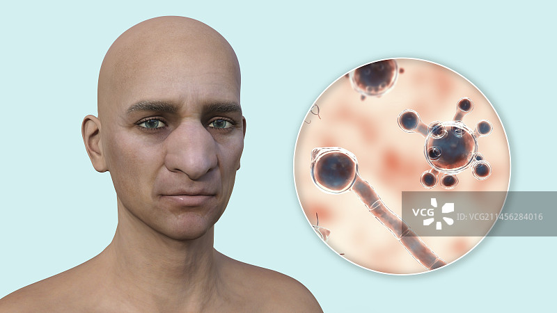 鼻面毛霉菌病和真菌插图图片素材