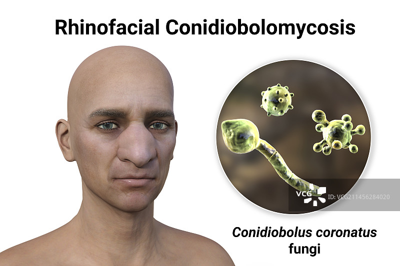 鼻面毛霉菌病和真菌插图图片素材