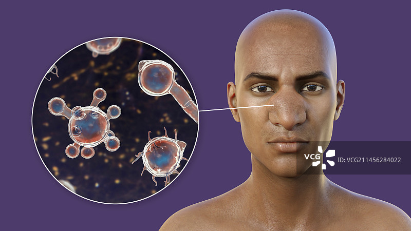 鼻面毛霉菌病和真菌插图图片素材