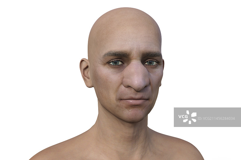 鼻面结合孢子菌病插图图片素材