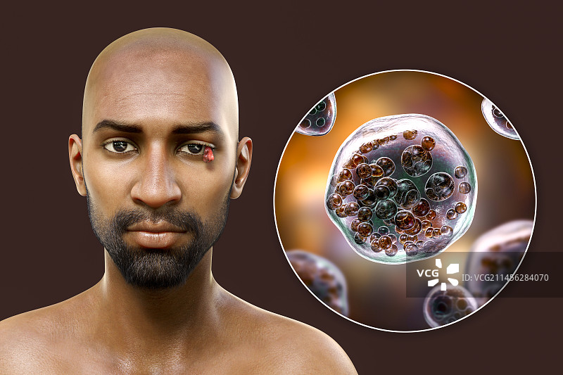 眼鼻孢子虫病插图图片素材