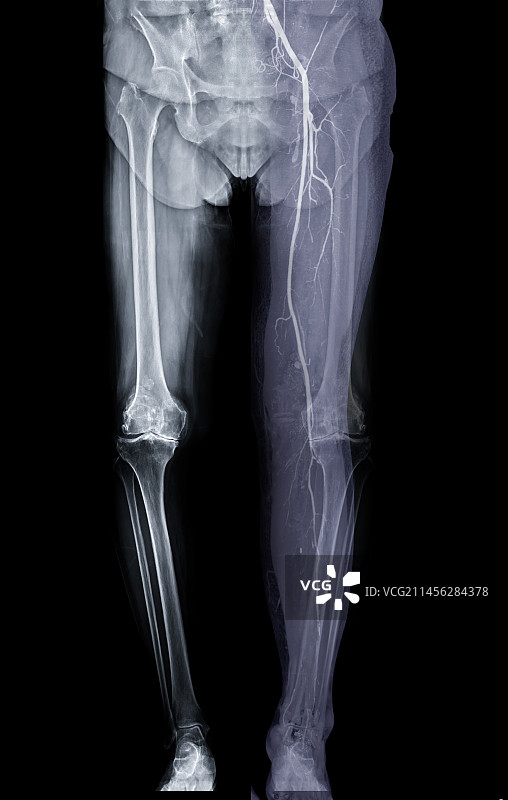 健康的下半身X光片图片素材