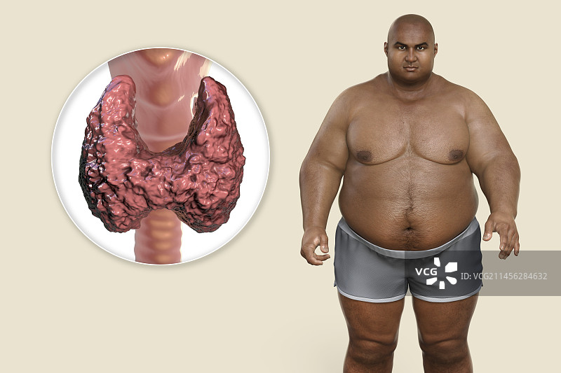 甲状腺疾病与肥胖概念图图片素材