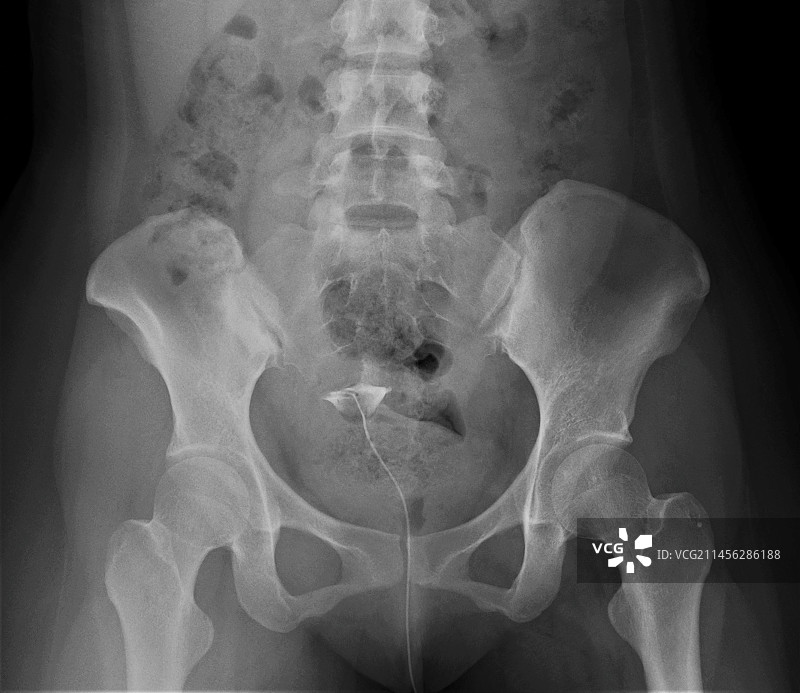 输卵管阻塞X光片图片素材