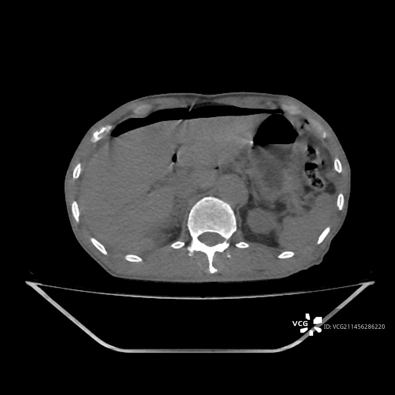 气腹CT扫描图片素材