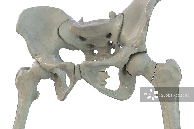 股骨颈骨折图示图片素材