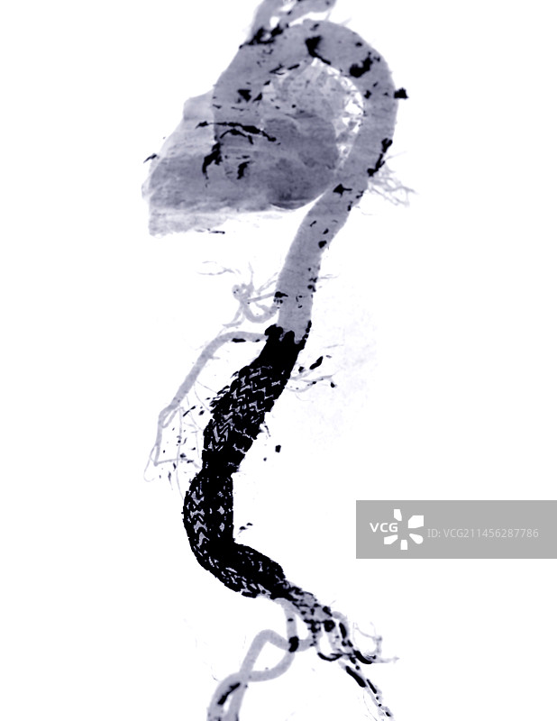 主动脉瘤中的支架，CT扫描图片素材