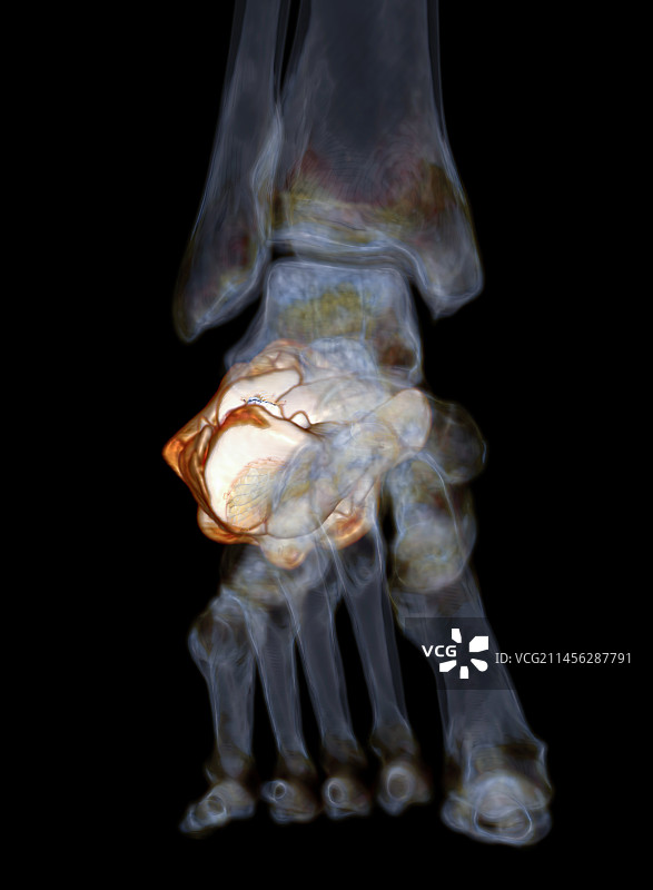 跟骨骨折CT扫描图片素材