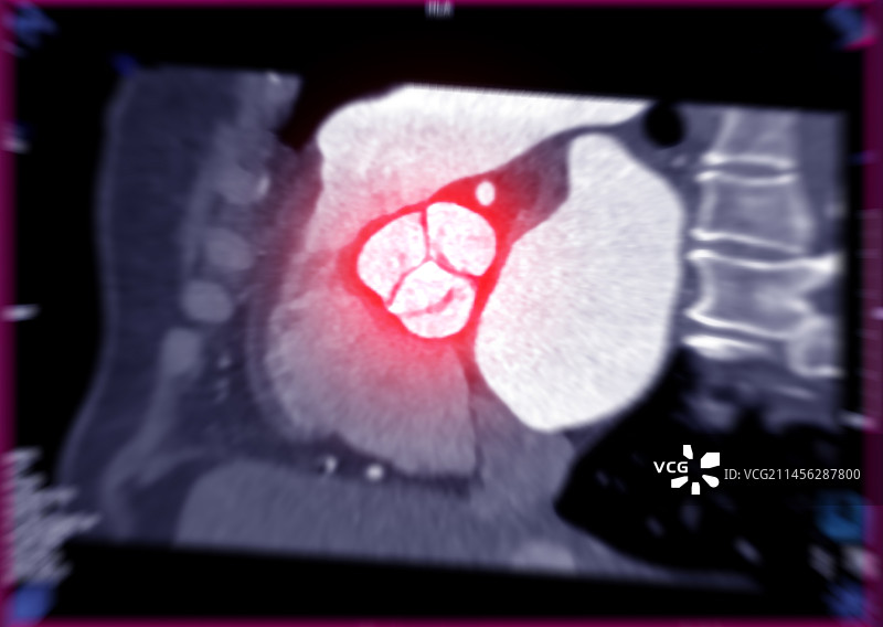 健康的主动脉瓣CT扫描图片素材