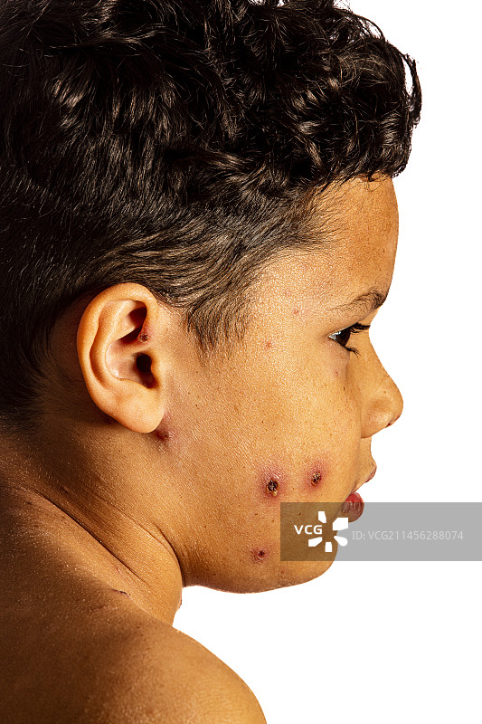 患有水痘的男孩图片素材