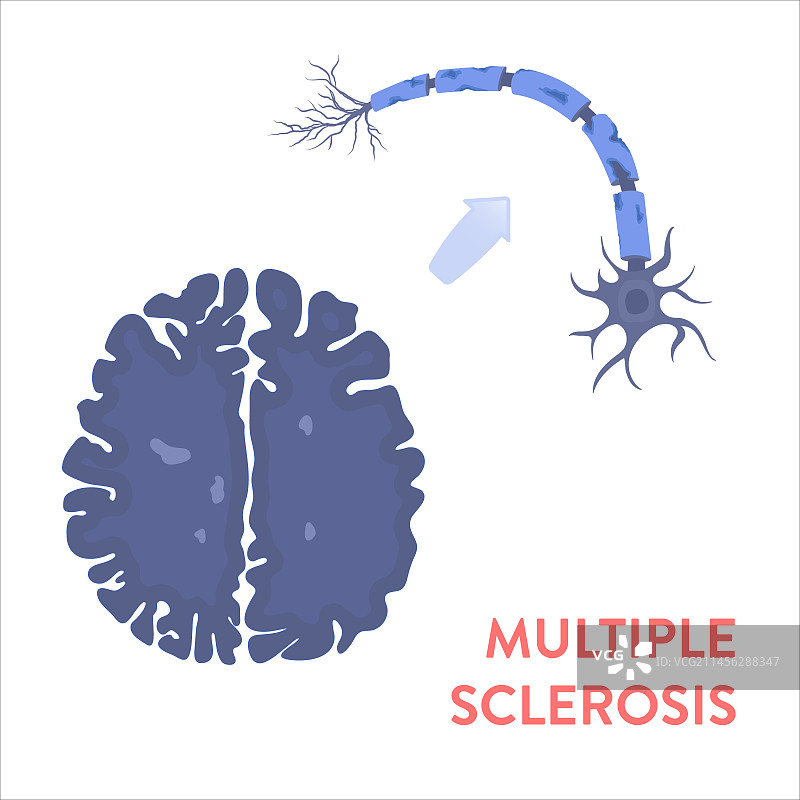 多发性硬化症概念图图片素材