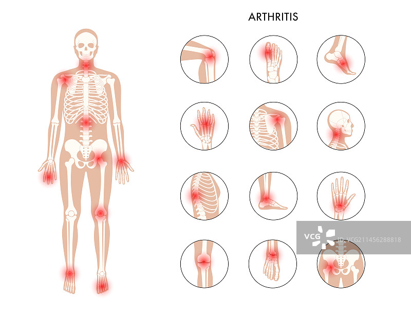 关节炎概念插图图片素材
