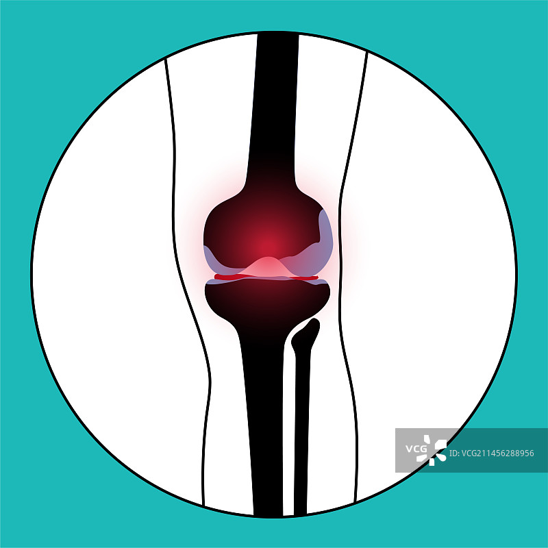 膝关节炎概念图图片素材