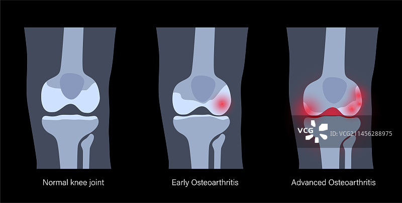 膝关节炎概念图图片素材