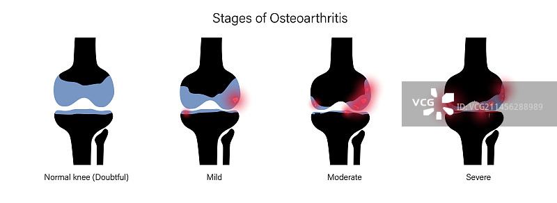 膝关节炎概念图图片素材