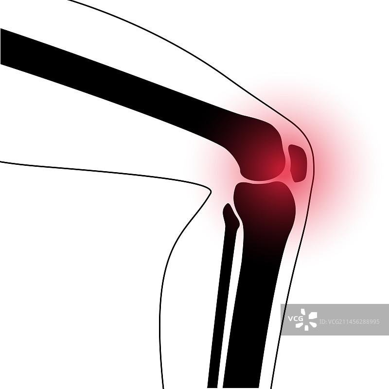 膝关节炎概念图图片素材