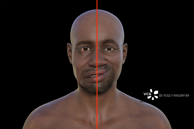 面瘫图示图片素材