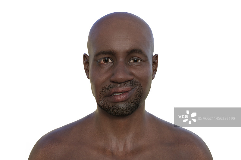 面瘫图示图片素材