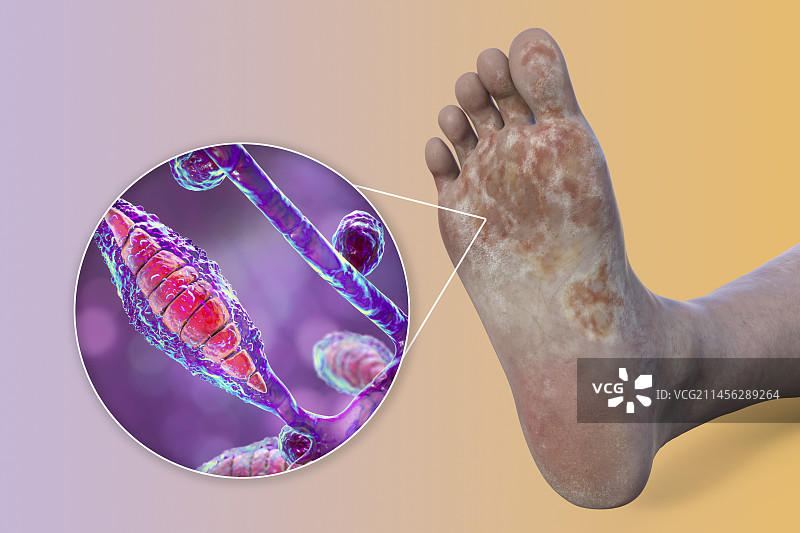 犬小孢子菌足部感染插图图片素材
