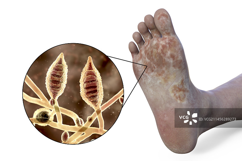 犬小孢子菌足部感染插图图片素材
