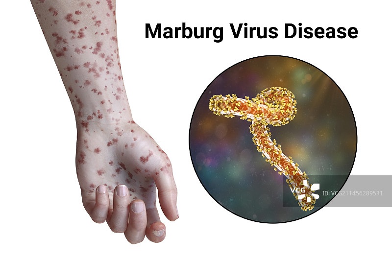 马尔堡出血热皮疹插图图片素材