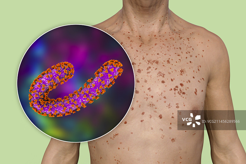 马尔堡出血热皮疹插图图片素材