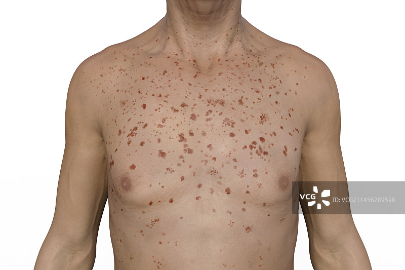 马尔堡出血热皮疹插图图片素材