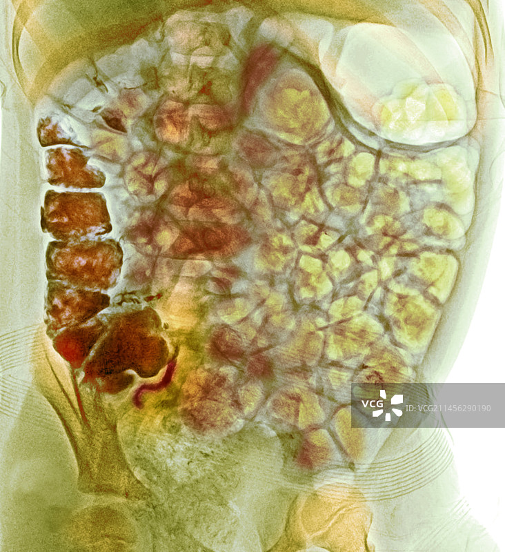 正常阑尾造影图片素材