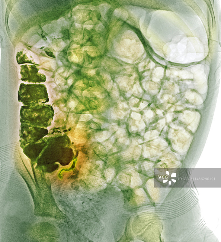 正常阑尾造影图片素材